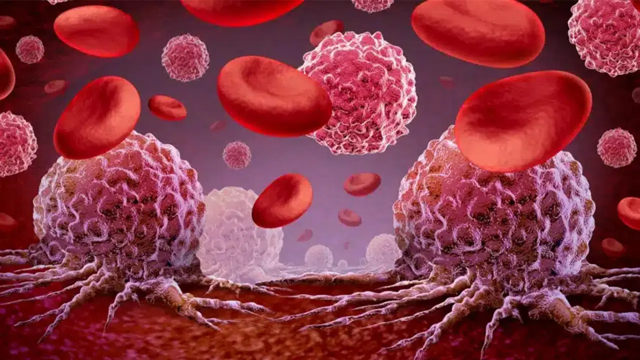 lenfoma erken teshisle buyuk oranda tedavi edilebiliyor iqqUXgJP